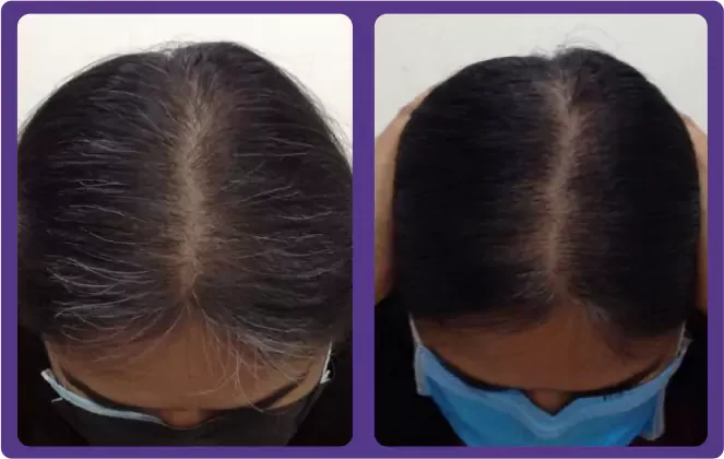 Exosomes + Microneedling Before & After