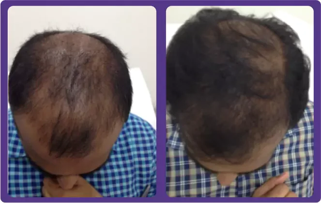 Hairfall Treatment Before & After